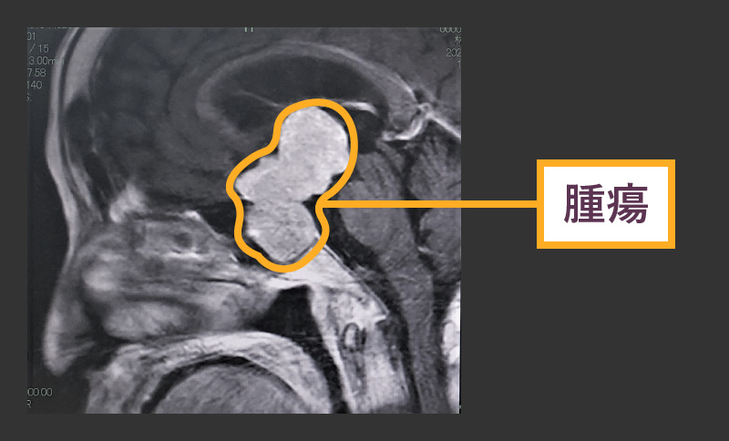 下垂体腫瘍はなぜ頭痛を引き起こすのでしょうか?
