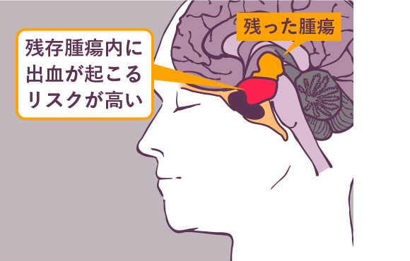 下垂体腫瘍手術後の人生への備え方