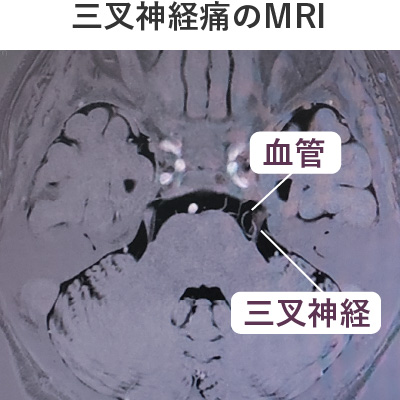 三叉神経痛のMRI