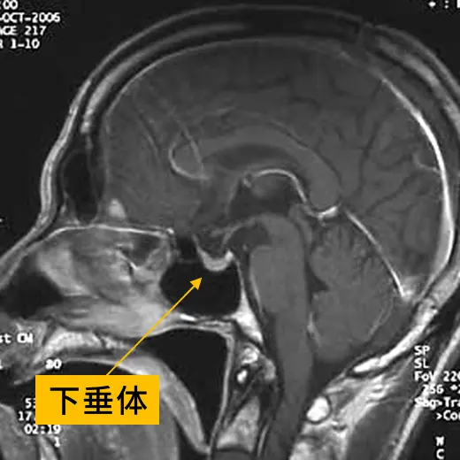 下垂体の模型とMRI